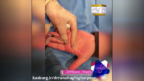 تزریق بوتاکس برای تعریق کف دست