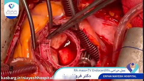 1401.01.30 - عمل جراحی RA mass TV Endocarditis