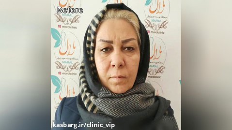 2 ماه بعد از جراحی بلفاروپلاستی-کلینیک vip تهران