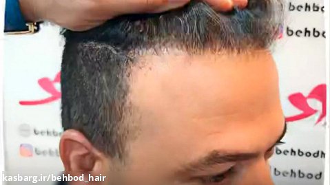 افزایش تراکم مو در ناحیه جلوی سر - بهترین روش کاشت مو