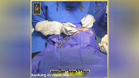 بلفاروپلاستی پلک افتاده و نتیجه درمان افتادگی پلک-کلینیک vip تهران