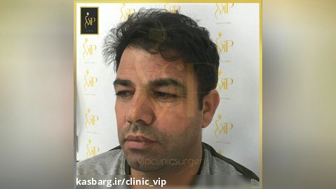 عمل ترکیبی پلک و تغییر باورنکردنی چهره-کلینیک vip تهران