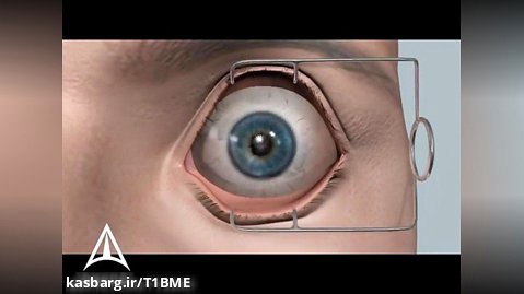 Refractive Surgery- Lasik Surgery - 3D Medical Animation
