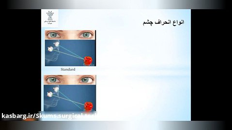انحراف چشم ( دانشگاه علوم پزشکی شهرکرد)