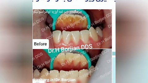 جرمگیری دندان - بهترین دندانپزشک اصفهان دکتر حسین برجیان