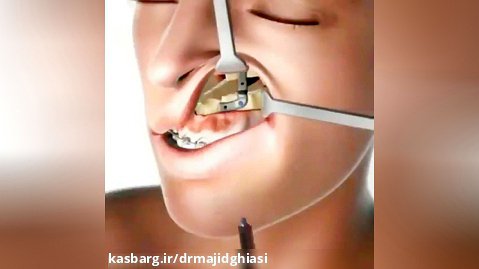 جراحی ارتودنسی دندان