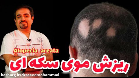 ریزش موی سکه ای | دکتر سعید محمدی