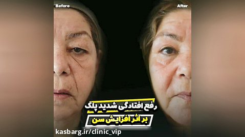 درمان افتادگی پلک در تهران- کلینیک vip تهران