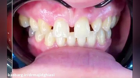 حذف فاصله بین دندانی