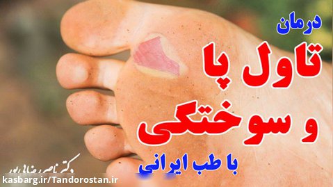 راههای درمان تاول پا و سوختگی از زبان پزشک متخصص طب ایرانی