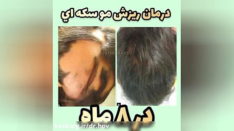 درمان ریزش مو برای همیشه!