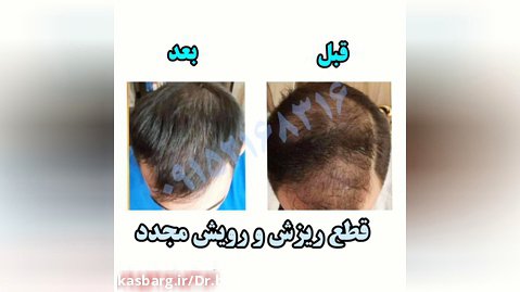 درمان ریزش مو و رشد مجدد(صددرصد درمان)
