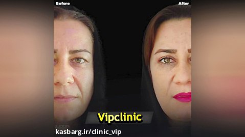 درمان افتادگی پلک در تهران-کلینیک vip تهران