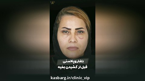 بلفاروپلاستی قبل از کشیدن بخیه- کلینیک Vip تهران