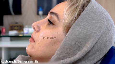 عمل جراحی زیبایی بینی در تهران توسط دکتر حسام اسکندرزاده