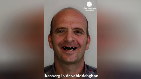 کلینیک دندان پزشکی دکتر دهقان : ایمپلنت فول فک
