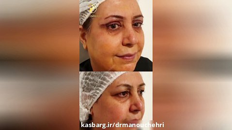 قبل و بعد از جراحی پلک | دکتر منوچهری
