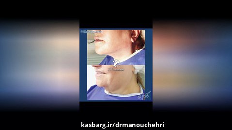 قبل و بعد از جراحی غبغب | دکتر منوچهری