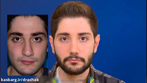 قبل و بعد از عمل طبیعی بینی  | دکتر فرشید آچاک