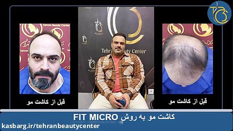 کاشت مو در تهران بیوتی سنتر