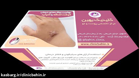 روش های درمان گوشت اضافه یا کلوئید | کاشت مو اصفهان