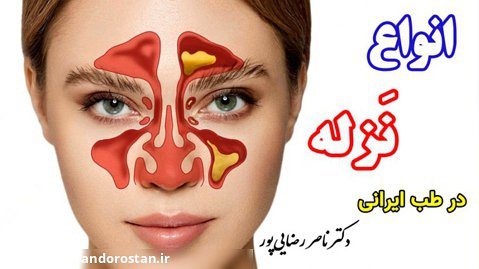 آشنایی با انواع نزله در طب ایرانی با دکتر ناصر رضایی پور