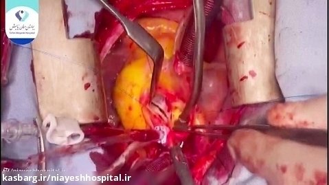 عمل جراحی قلب - AVR Reduction aortoplasty