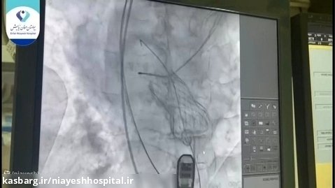 عمل جراحی قلب - TAVIدر بيمار خانم ٨٢ ساله