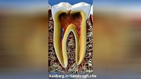 عصب کشی دندان -دانستنی
