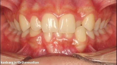 درمان نامرتبی دندان ها با ارتودنسی دیمون | دکتر داودیان