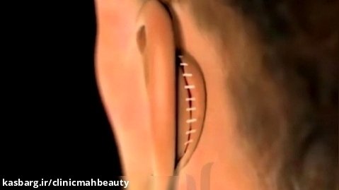 عمل جراحی زیبایی گوش (اتوپلاستی)