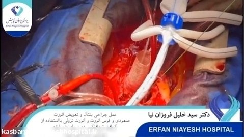 دکتر سید خلیل فروزان نیا - عمل جراحی قلب بنتال و تعویض آئورت صعودی