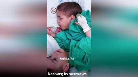جداسازی دوقلوهای به هم چسبیده سوری توسط پزشکان عربستان سعودی