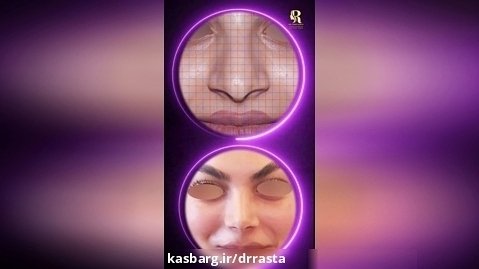   جراحی زیبایی بینی انجام شده توسط دکتر نسرین راستا
